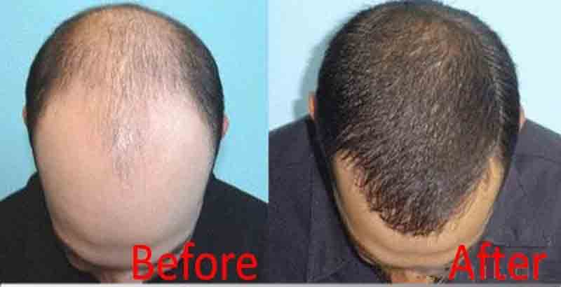 Hair Loss solution